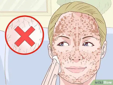 Immagine titolata Treat Acne (Teenage Girls) Step 4