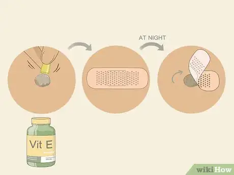 Immagine titolata Get Rid of Warts Step 13