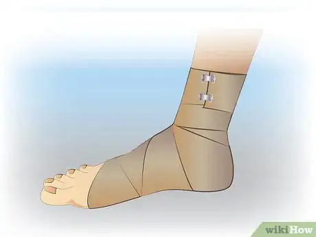 Immagine titolata Ace Wrap a Leg Step 10