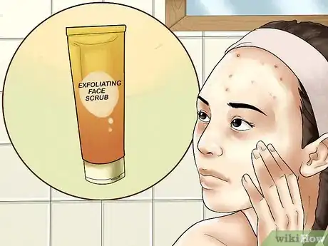 Immagine titolata Get Rid of Forehead Acne Step 12