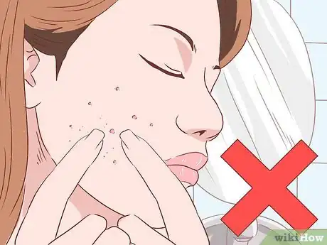 Immagine titolata Treat Acne (Teenage Girls) Step 8