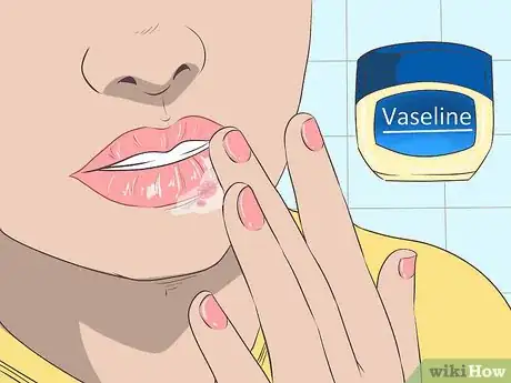 Immagine titolata Treat a Cold Sore or Fever Blisters Step 17