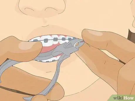 Immagine titolata Temporarily Fix a Loose Wire on Your Braces Step 11