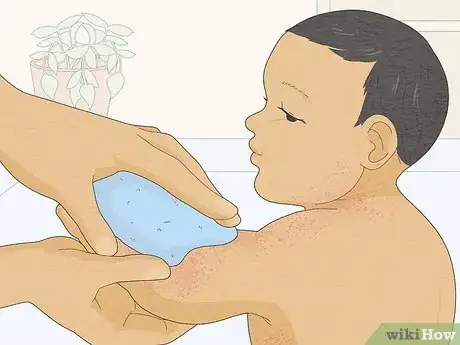 Immagine titolata Treat Baby Heat Rash Step 4