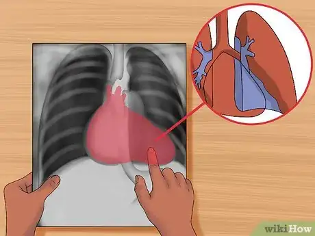 Immagine titolata Read a Chest X Ray Step 16