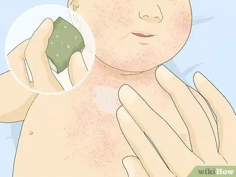 Immagine titolata Treat Baby Heat Rash Step 5