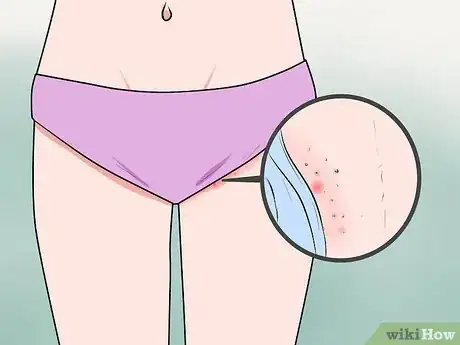 Immagine titolata Recognize Vulva Cancer Symptoms Step 1
