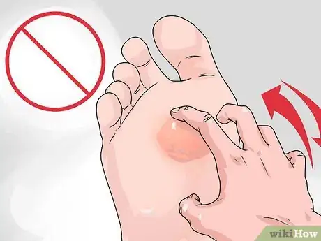 Immagine titolata Care for a Burst Blister Step 9
