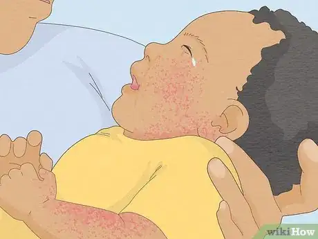 Immagine titolata Treat Baby Heat Rash Step 9