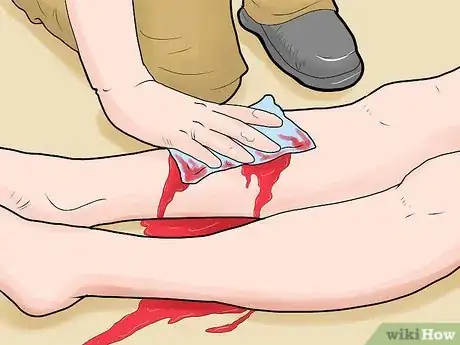 Immagine titolata Treat an Open Fracture During First Aid Step 4