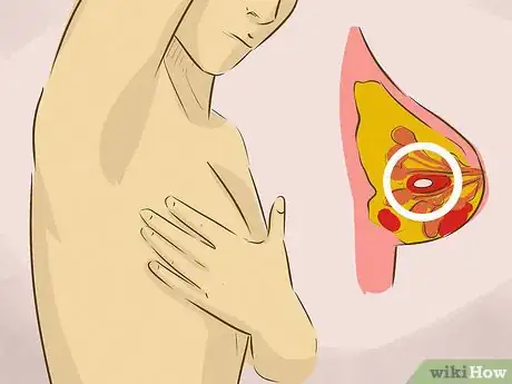 Immagine titolata Identify a Lump in a Breast Step 3