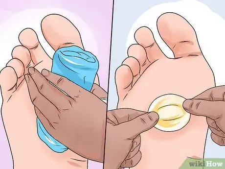 Immagine titolata Care for a Burst Blister Step 8