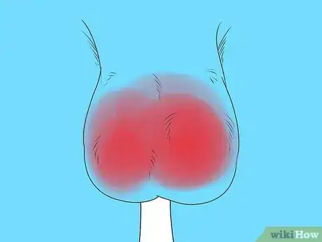 Immagine titolata Know if You Have Epididymitis Step 2