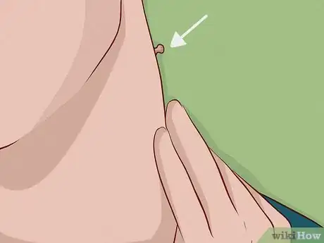 Immagine titolata Remove a Skin Tag from Your Neck Step 5