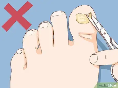 Immagine titolata Help a Toenail Grow Back Quickly Step 9