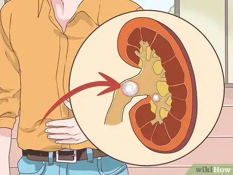 Immagine titolata Know if You Have Kidney Problems Step 1