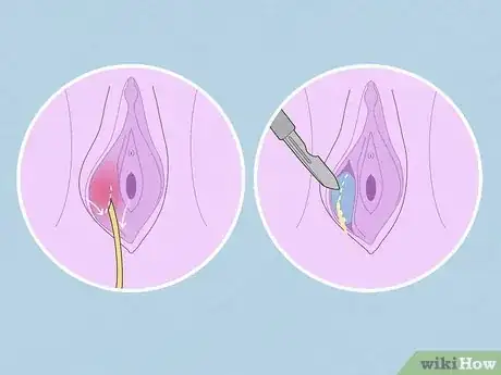 Immagine titolata Treat Vaginal Cysts Step 4