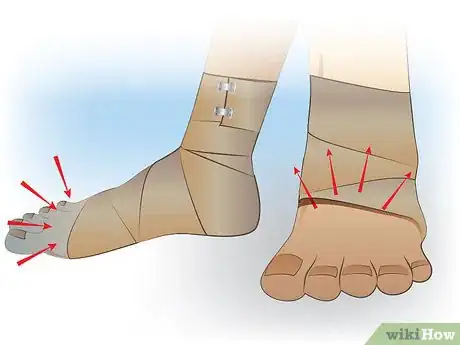 Immagine titolata Ace Wrap a Leg Step 11