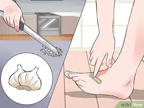 Immagine titolata Treat a Wart at Home Step 6