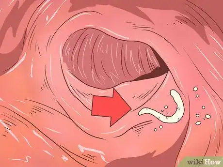 Immagine titolata Recognize and Prevent a Pinworm Infection Step 3