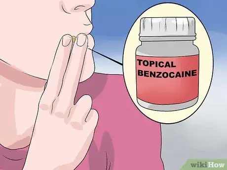 Immagine titolata Stop a Mouth Ulcer from Hurting Step 14