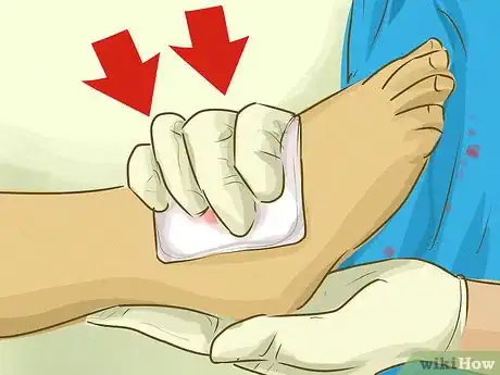 Immagine titolata Stop Bleeding Step 18