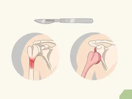 Immagine titolata Fix a Dislocated Shoulder Step 9