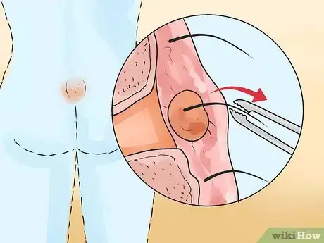 Immagine titolata Get Rid of a Cyst Step 12