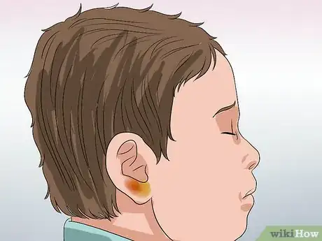 Immagine titolata Know if You Have Otitis Media Step 12