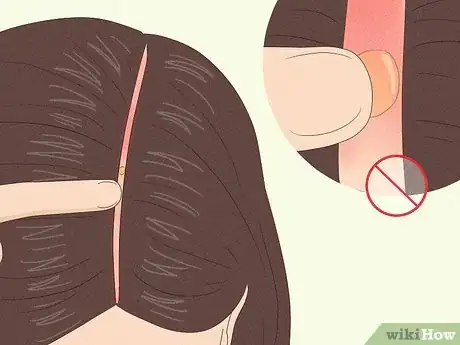 Immagine titolata Deal with a Scalp Sunburn Step 4