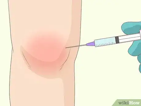 Immagine titolata Heal a Meniscus Tear Step 8