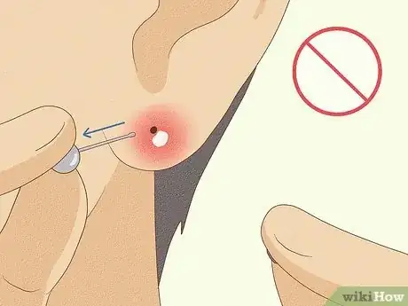 Immagine titolata Treat Infected Piercings Step 14