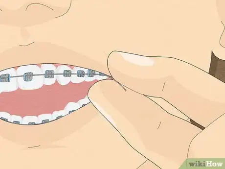 Immagine titolata Temporarily Fix a Loose Wire on Your Braces Step 10