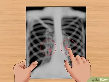 Immagine titolata Read a Chest X Ray Step 20