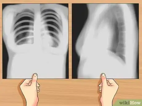 Immagine titolata Read a Chest X Ray Step 8