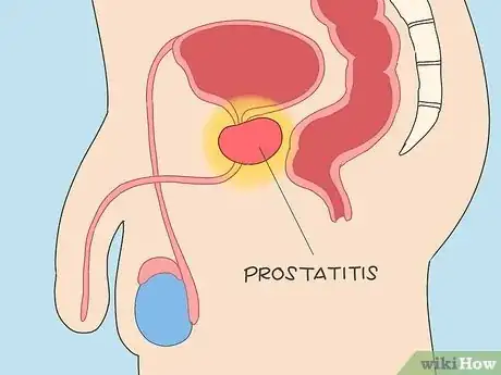 Immagine titolata Reduce Prostate Pain Step 3