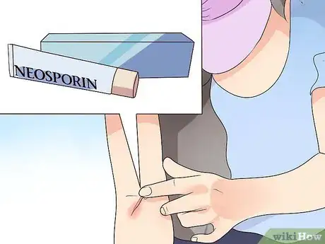 Immagine titolata Get Rid of a Cut Step 7