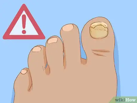 Immagine titolata Help a Toenail Grow Back Quickly Step 15