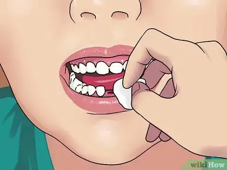 Immagine titolata Stop the Bleeding After You Pull out a Loose Tooth Step 3