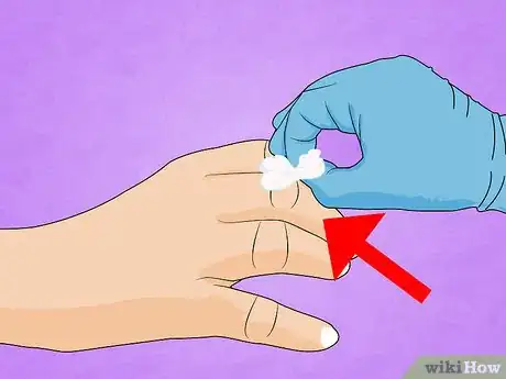 Immagine titolata Treat a Broken Finger Step 13