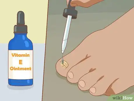Immagine titolata Help a Toenail Grow Back Quickly Step 11