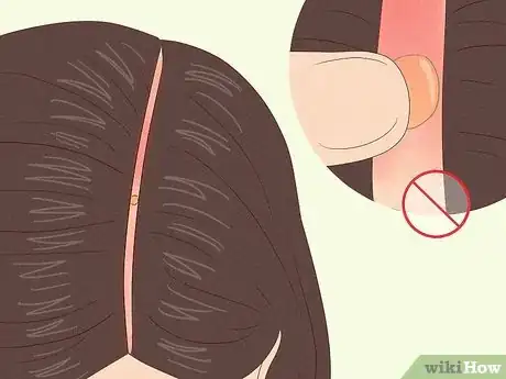 Immagine titolata Deal with a Scalp Sunburn Step 4