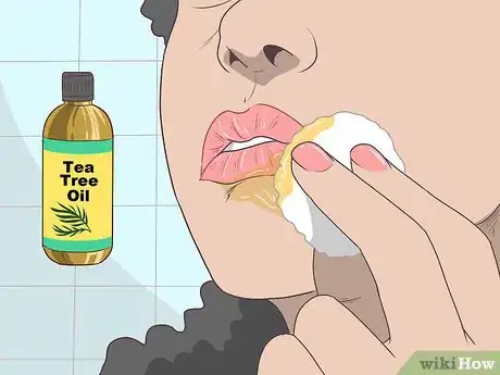 Immagine titolata Treat a Cold Sore or Fever Blisters Step 15