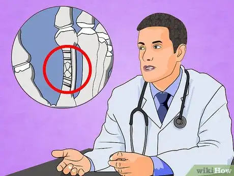 Immagine titolata Treat a Broken Finger Step 11