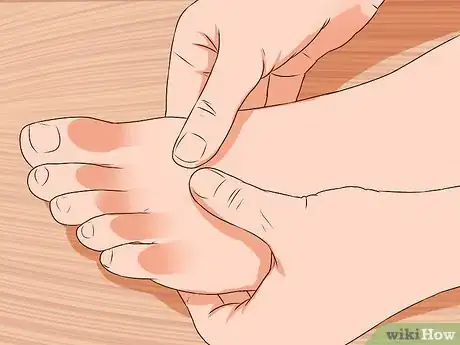 Immagine titolata Relieve Bunions Step 7