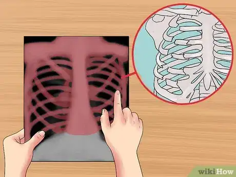 Immagine titolata Read a Chest X Ray Step 15