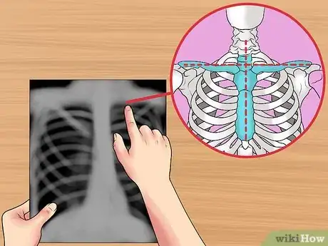 Immagine titolata Read a Chest X Ray Step 6