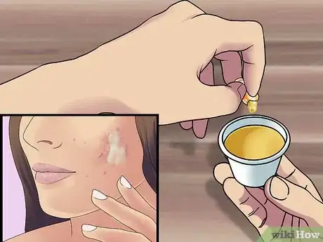 Immagine titolata Get Rid of Cystic Acne Scars Step 4