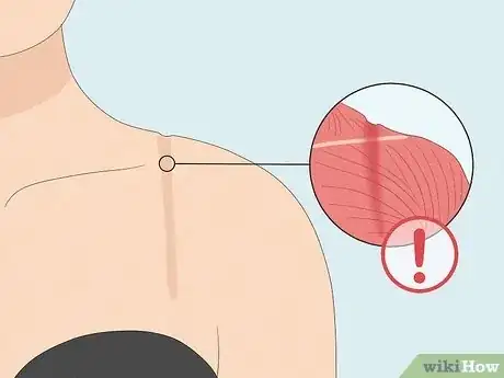 Immagine titolata Get Rid of Bra Indentations on Shoulder Step 11