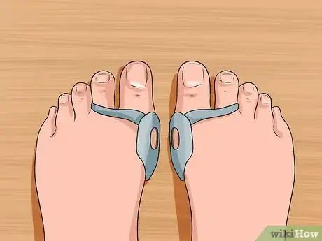 Immagine titolata Get Rid of Bunions Step 5